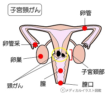 子宮頸がんの原因と症状