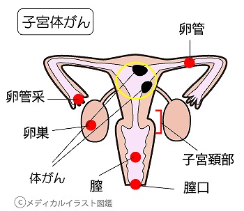 子宮体がんの原因と症状