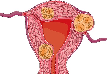 子宮筋腫って？